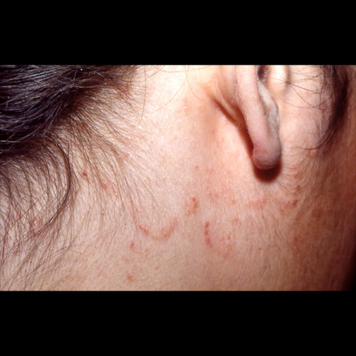 Dermatite seborroica. Interessamento della faccia laterale del collo